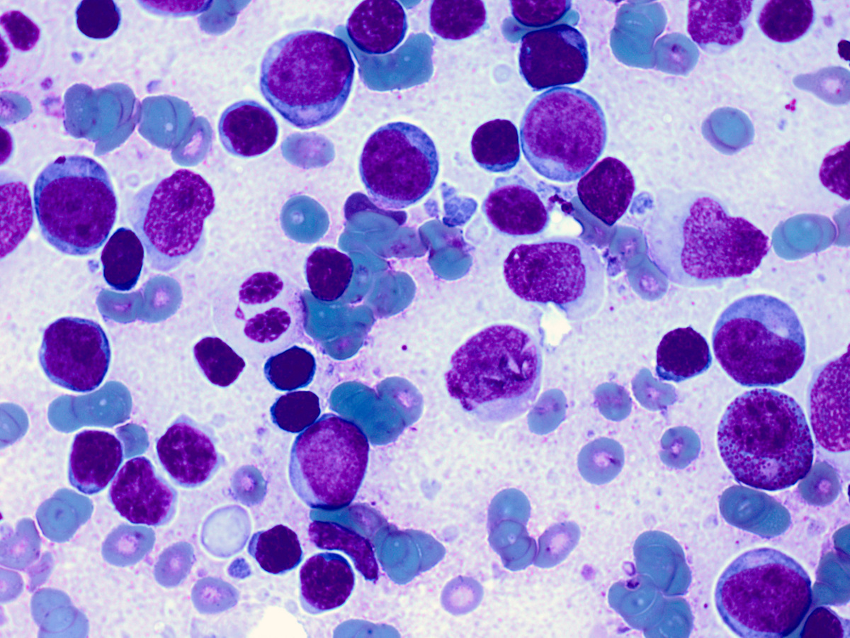 FNA of the pelvic lymph node showing population of blasts in a background of small mature lymphocytes. More mature myeloid/ eosinophilic precursor is seen in lower right (x100, Diff-Quik stain)